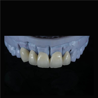 Aesthetic and Strong Zirconia Crown
